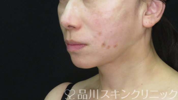 症例NO.72809のAFTER写真