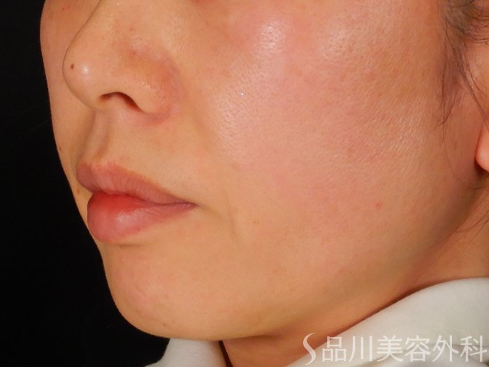症例NO.67940のBEFORE写真