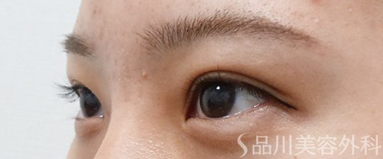 症例NO.62274のAFTER写真