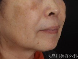 症例NO.73530のBEFORE写真