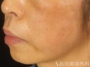 症例NO.72732のAFTER写真