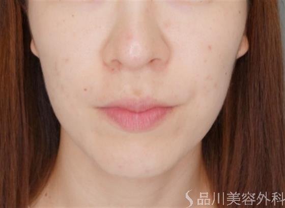 症例NO.53317のBEFORE写真