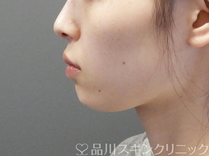 症例NO.70601のBEFORE写真