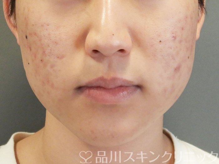 症例NO.65170のAFTER写真