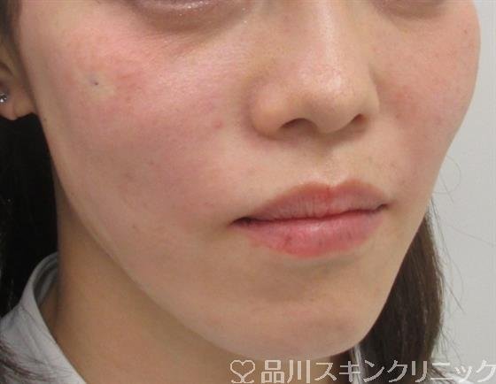 症例NO.29709のAFTER写真