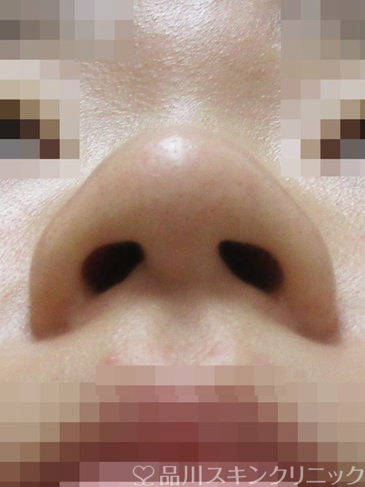 症例NO.70200のBEFORE写真