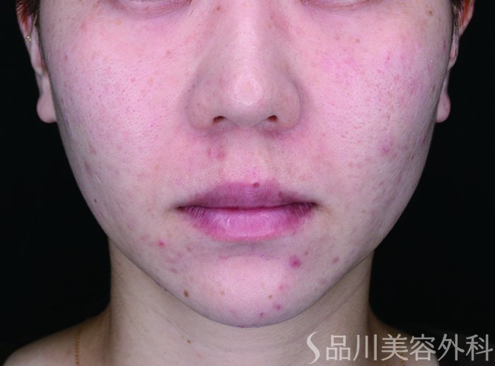 症例NO.72919のBEFORE写真