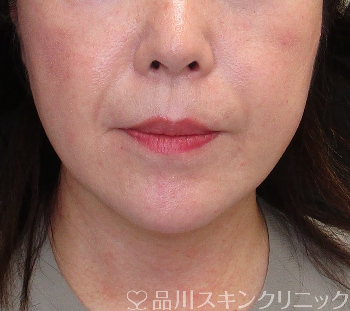 症例NO.73418のBEFORE写真