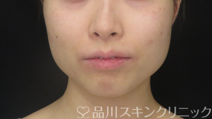 症例NO.72287のAFTER写真