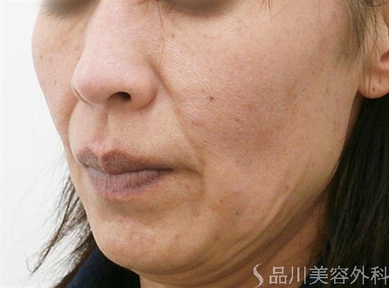 症例NO.25629のAFTER写真