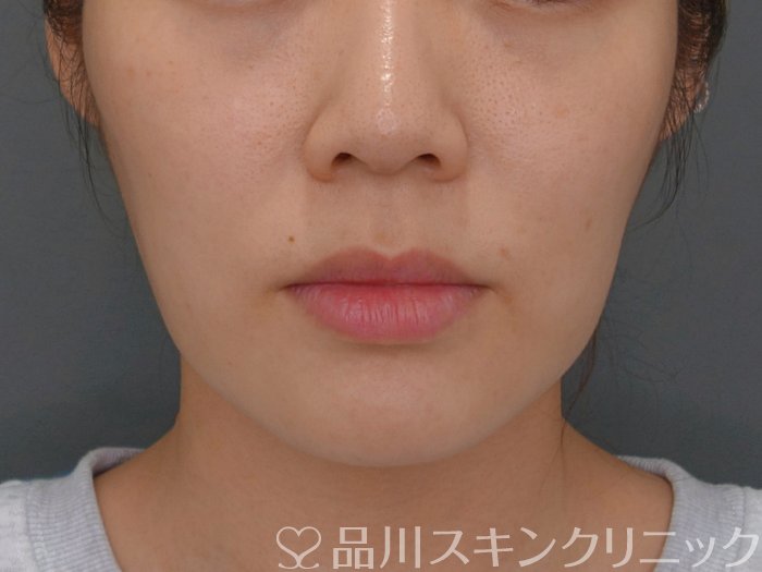 症例NO.73802のBEFORE写真