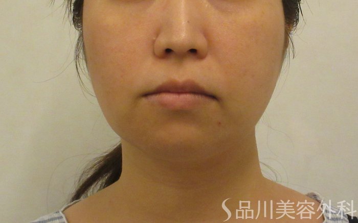 症例NO.71565のBEFORE写真