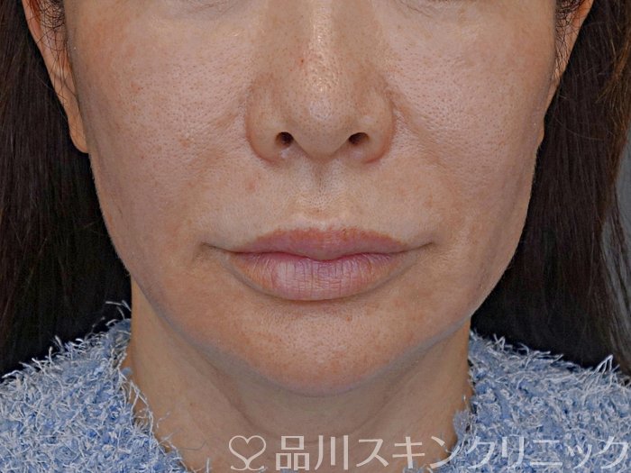 症例NO.73994のBEFORE写真