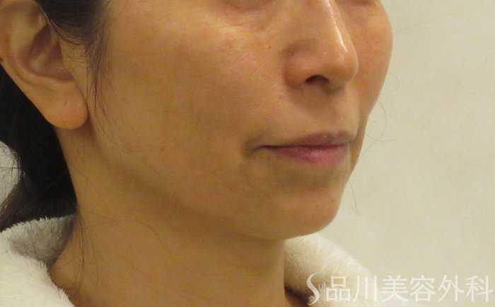症例NO.69410のBEFORE写真