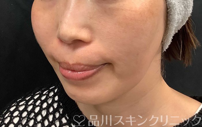 症例NO.71036のBEFORE写真
