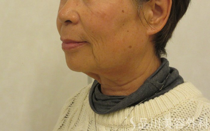 症例NO.72253のBEFORE写真