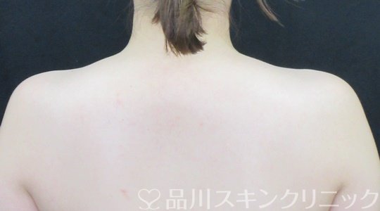 症例NO.70123のBEFORE写真