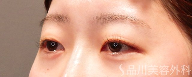 症例NO.69366のAFTER写真