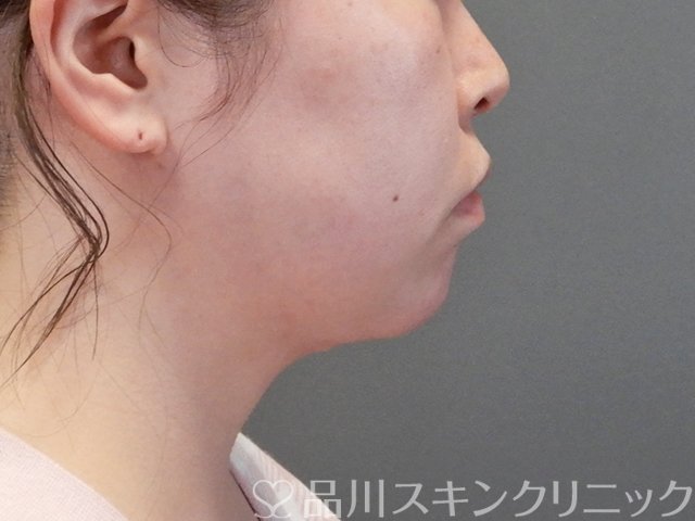 症例NO.63310のAFTER写真