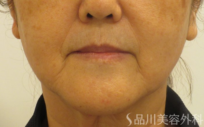 症例NO.73535のBEFORE写真