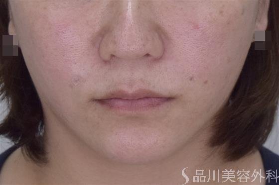 症例NO.50469のAFTER写真