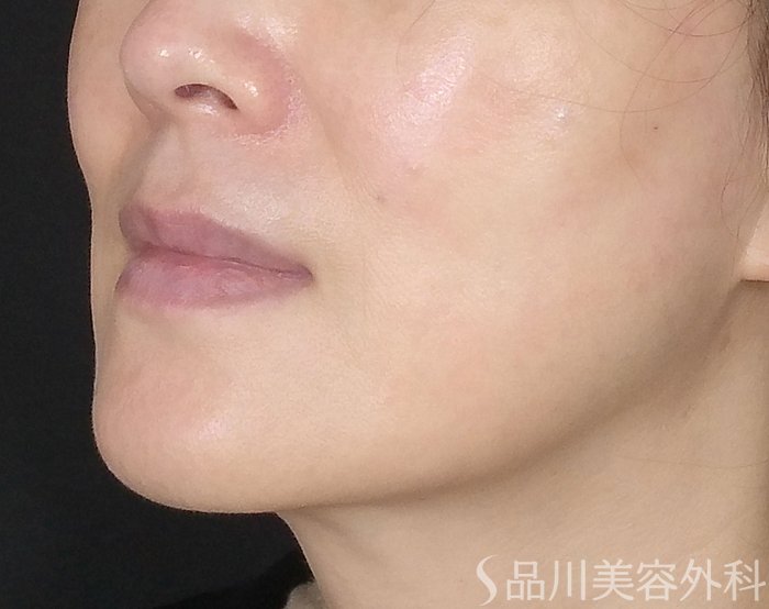 症例NO.70450のBEFORE写真