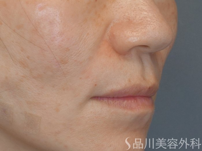 症例NO.72892のAFTER写真