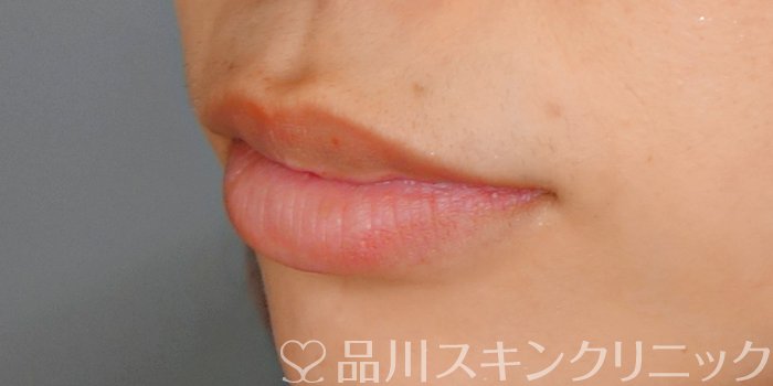 症例NO.70899のBEFORE写真