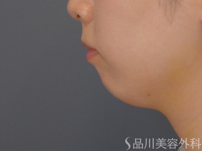 症例NO.65447のBEFORE写真