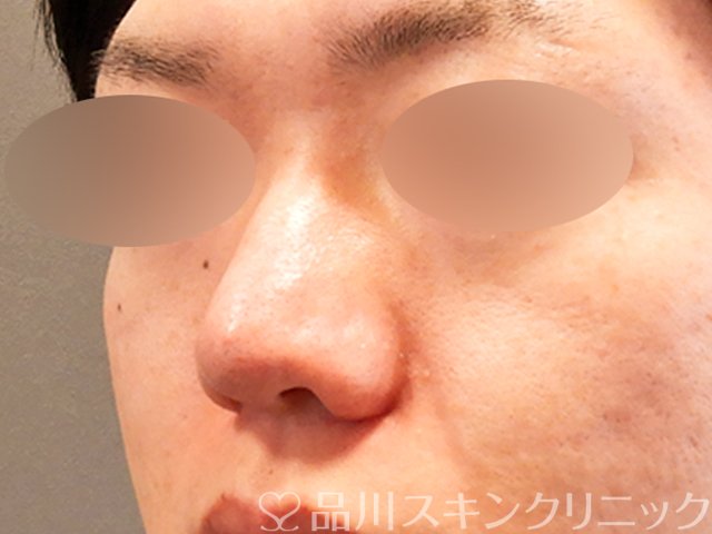 症例NO.70282のAFTER写真