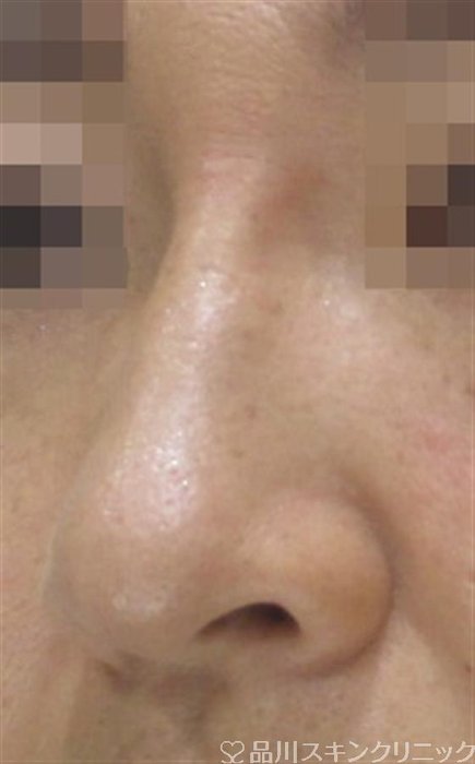 症例NO.35124のAFTER写真