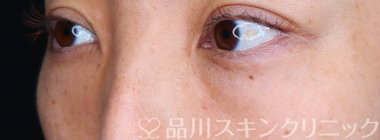 症例NO.74835のBEFORE写真