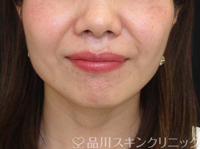 症例NO.65418のAFTER写真