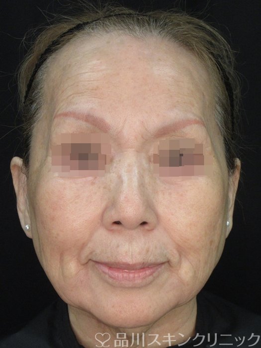 症例NO.72583のAFTER写真