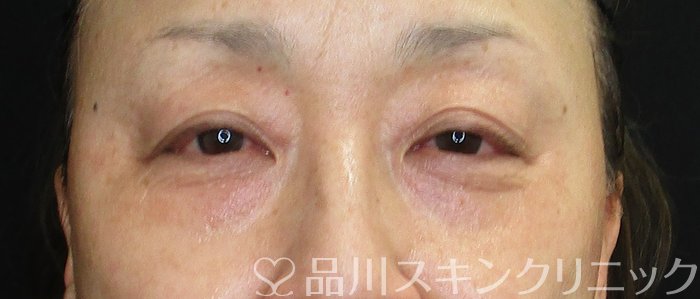 症例NO.75099のBEFORE写真
