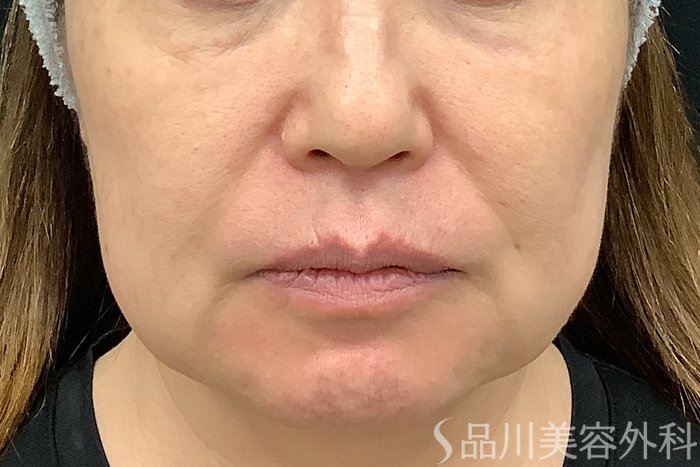 症例NO.71251のBEFORE写真