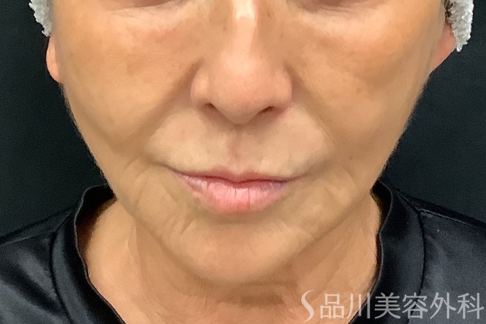 症例NO.67806のBEFORE写真