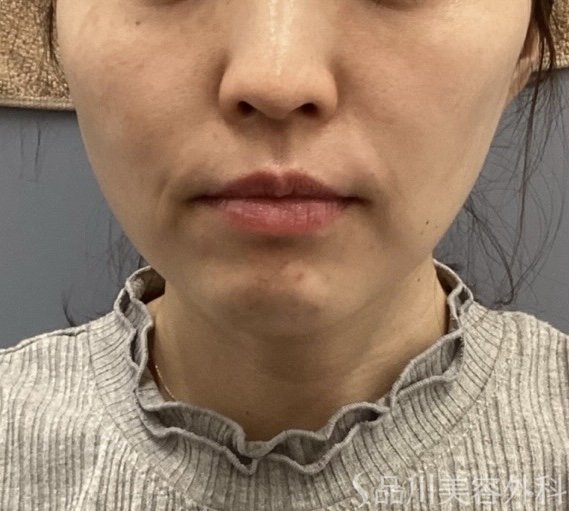 症例NO.75168のBEFORE写真