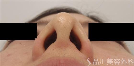 症例NO.14918のAFTER写真