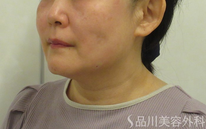 症例NO.72342のAFTER写真