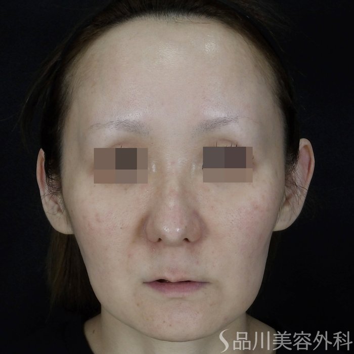 症例NO.70274のBEFORE写真