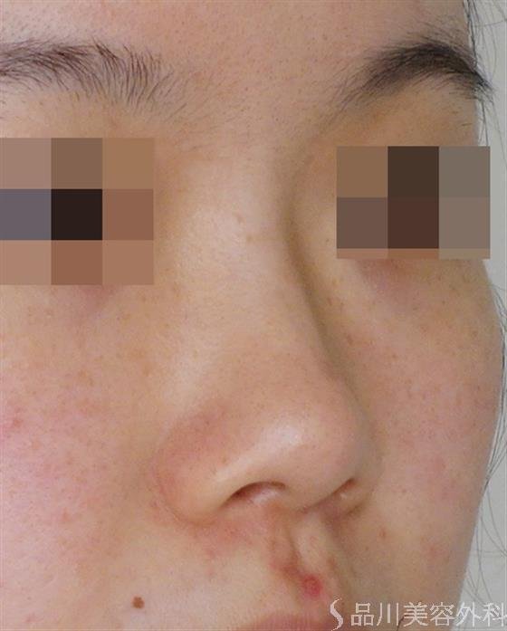 症例NO.51249のBEFORE写真