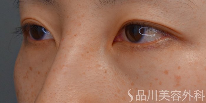 症例NO.64817のBEFORE写真