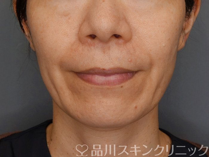 症例NO.71381のBEFORE写真