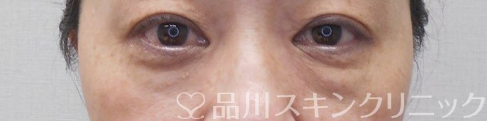 症例NO.70543のBEFORE写真