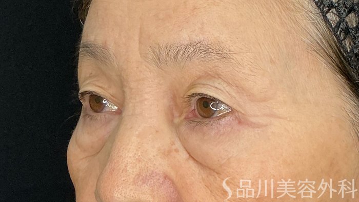 症例NO.72224のBEFORE写真