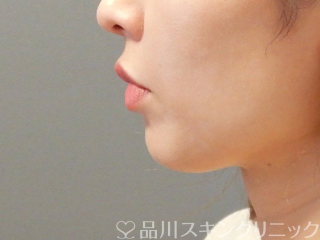 症例NO.64984のBEFORE写真