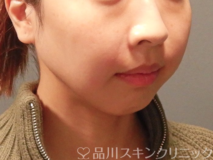 症例NO.63155のAFTER写真