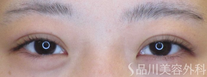 症例NO.65400のAFTER写真