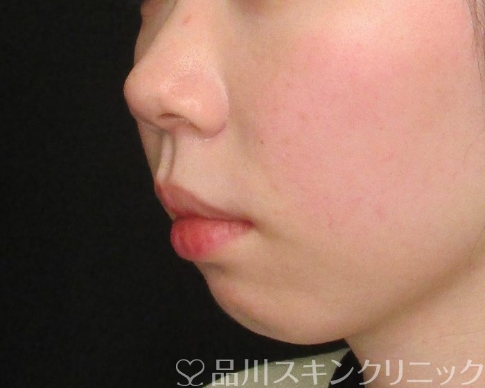 症例NO.69740のBEFORE写真